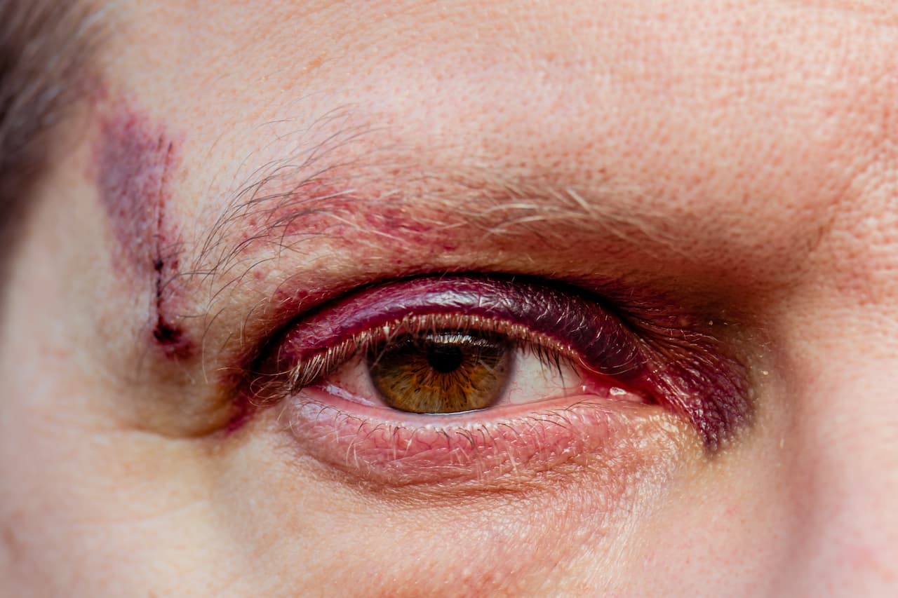 Carbide Tooth/Tip Detachment: Why it can be Catastrophic